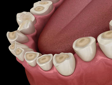 Dental attrition (Bruxism) resulting in loss of tooth tissue.  Medically accurate tooth 3D illustrationの写真素材