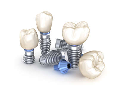 Dental Implants. 3D illustration concept of human teeth