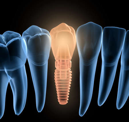 Premolar tooth recovery with implant, x-ray view. Medically accurate 3D illustration of human teeth and dentures conceptの写真素材