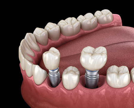 Premolar and Molar tooth crown installation over implant - concept. 3D illustration of human teeth...