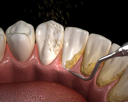 Oral hygiene: Ultrasonic teeth cleaning machine removing calculus and plaque. Medically accurate 3D...
