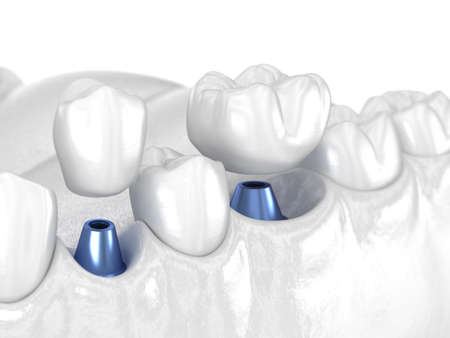 Premolar and Molar tooth crown installation over implant - white concept. 3D illustration of human...