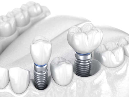 Premolar and Molar tooth crown installation over implant - white concept. 3D illustration of human...