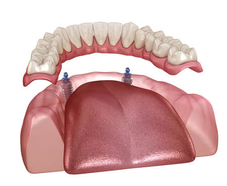 Mandibular removable prosthesis All on 2 system supported by implants with ball attachments....