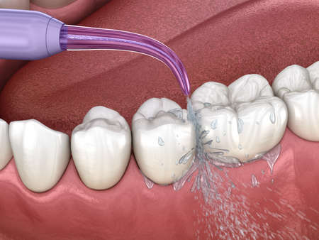 Irrigator, Water teeth cleaning. Medically accurate 3D illustration of oral hygiene.