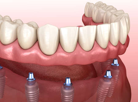 Mandibular prosthesis with gum All on 6 system supported by implants.  Medically accurate 3D...