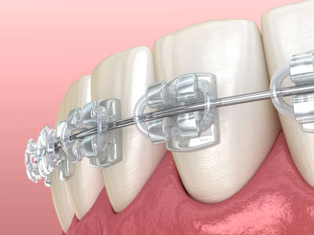 Mandibular jaw and Clear braces. Medically accurate dental 3D illustration
