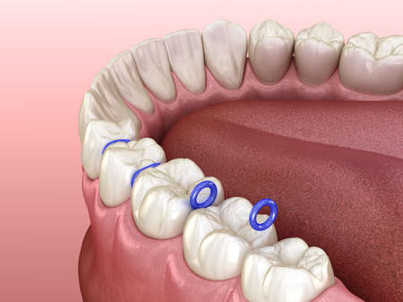 Rubber separator between teeth, preparation for braces placement. Medically accurate dental 3D...