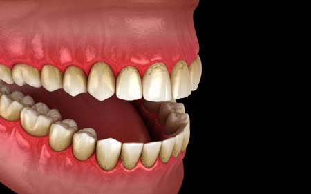Tartar and bactrail tooth plaque, jaw inflammation. Medically accurate 3D illustration of human...