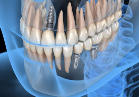 Central Incisor recovery by implant.  Medically accurate 3D illustration of dental concept