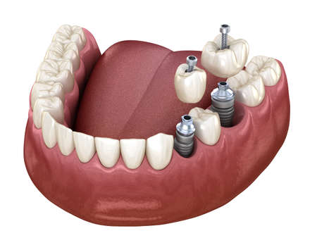 Premolar and Molar tooth crown installation over implant, screw fixation. 3D illustration of dental...