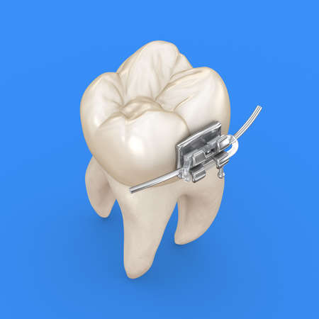 Tooth and metal braces. 3D illustration concept
