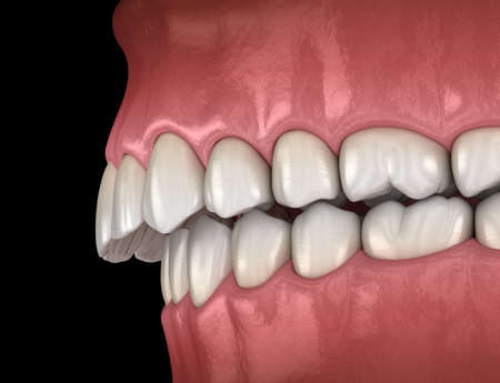 Overbite dental occlusion ( Malocclusion of teeth ). Medically accurate tooth 3D illustrationの写真素材