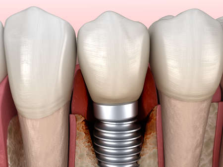 Periimplantitis with visible bone damage. Medically accurate 3D illustration of dental implants...
