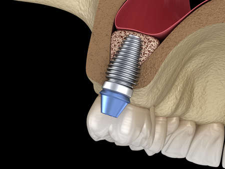 Sinus Lift Surgery - implant installation. 3D illustrationの写真素材