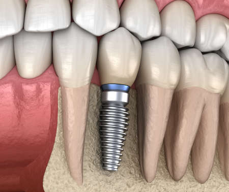 Premolar tooth recovery with implant. Medically accurate 3D illustration of human teeth and dentures conceptの写真素材