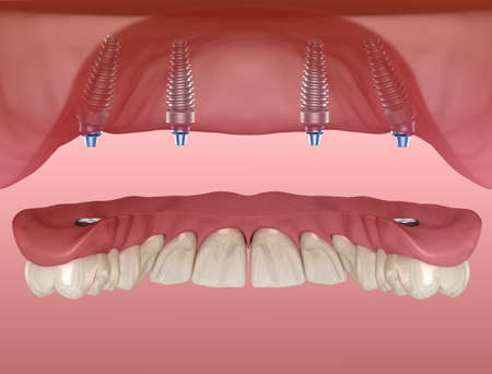 Maxillary prosthesis with gum All on 4 system supported by implants. Medically accurate 3D...