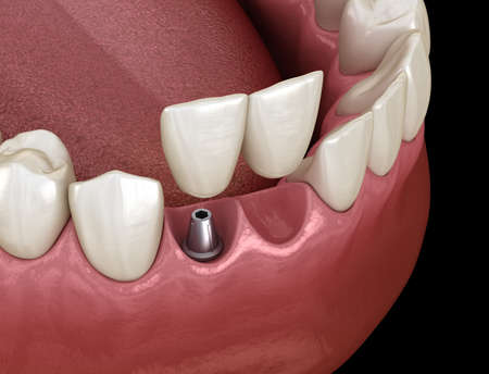 Cantilever bridge implant based, frontal tooth recovery. Medically accurate 3D animation of dental...