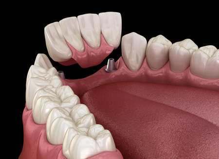 Frontal teeth bridge supported by implants. Medically accurate 3D animation of dental conceptの写真素材