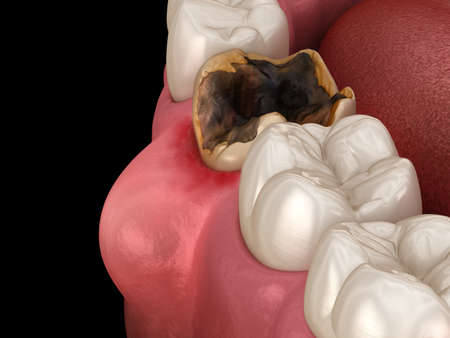 Periodontitis and gum inflammation. Medically accurate dental 3D illustrationの写真素材