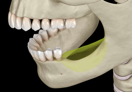 Mandibular Jaw, bone recession after losing molars teeth. Medically accurate dental 3D illustrationの写真素材