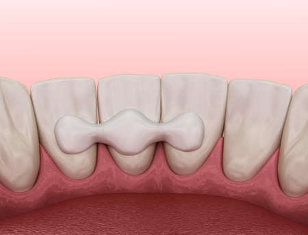 Maryland bridge made from ceramic, front tooth recovery. Medically accurate 3D illustration of dental conceptの写真素材