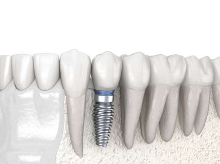 Premolar tooth recovery with implant. Medically accurate 3D illustration of human teeth and dentures...