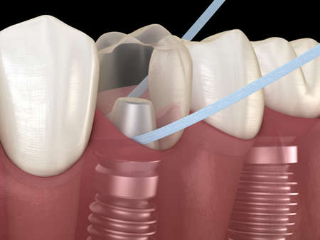 Implant tooth cleaning with dental floss. Medically accurate 3D illustration