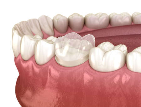 Preparated molar tooth for dental crown placement. Medically accurate 3D illustrationの写真素材