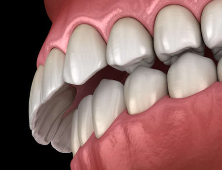 Overbite dental occlusion ( Malocclusion of teeth ). Medically accurate tooth 3D illustrationの写真素材