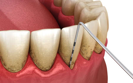 Periodontitis testing, gum recession process. Medically accurate 3D illustrationの写真素材
