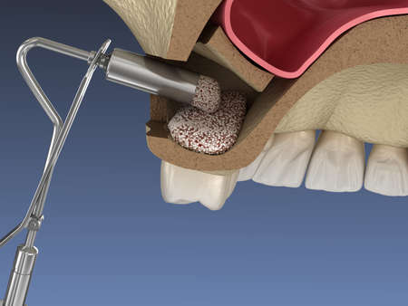 Sinus Lift Surgery - Adding new bone. 3D illustrationの写真素材