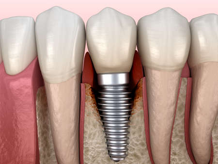 Periimplantitis with visible bone damage. Medically accurate 3D illustration of dental implants conceptの写真素材