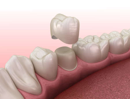 Preparated premolar tooth and dental crown placement. Medically accurate 3D illustrationの写真素材