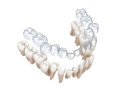 Invisalign braces or invisible retainer make bite correction. Medically accurate 3D animation