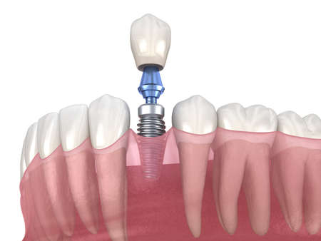 Premolar tooth recovery with implant. Medically accurate 3D illustration of human teeth and dentures...