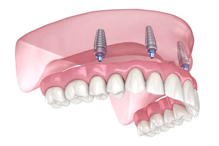 Maxillary prosthesis with gum All on 4 system supported by implants. Medically accurate 3D illustration of human teeth and denturesの写真素材
