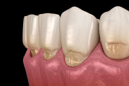 Abfraction of anterior teeth. Medically accurate 3D illustrationの写真素材