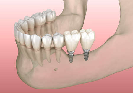 Implantation with mini implants in to recessed jaw bone: Medically accurate 3D illustration