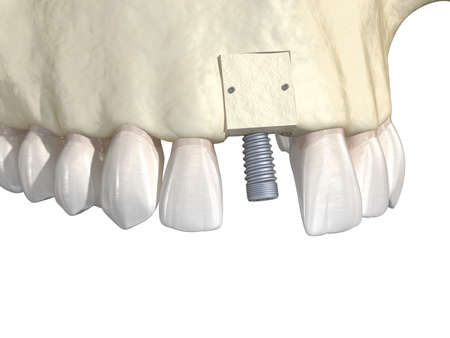 Bone grafting- augmentation using block of bone, tooth implantation. Medically accurate 3D...