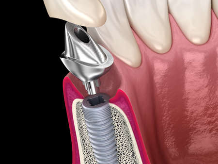 Custom abutment, dental implant and ceramic crown. Medically accurate tooth 3D illustration.