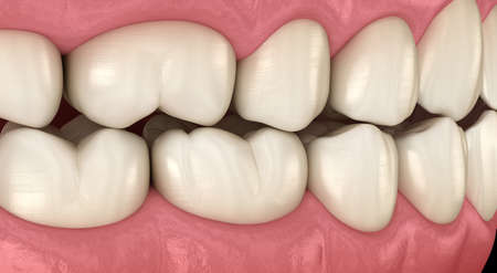 Traumatic Occlusion. Medically accurate 3D illustration