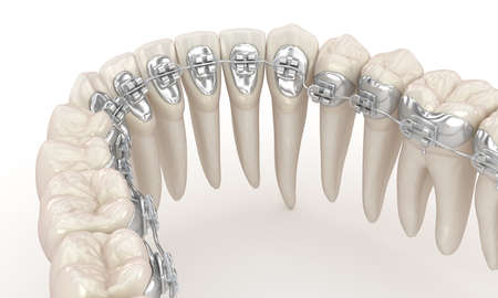 Lingual braces system. 3D illustration concept of silver bracesの写真素材