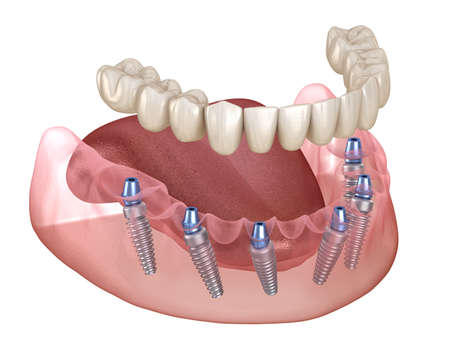 Mandibular prosthesis with gum All on 6 system supported by implants. Medically accurate 3D illustration of human teeth and dentures conceptの写真素材