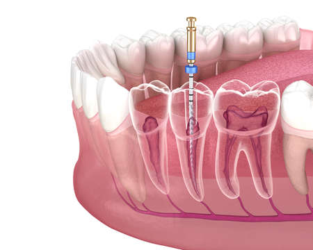 Endodontic root canal treatment process. Medically accurate tooth 3D illustration.の写真素材