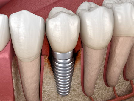 Periimplantitis with visible bone damage. Medically accurate 3D illustration of dental implants conceptの写真素材