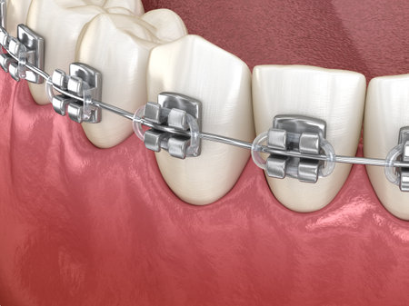 Healthy Teeth with metal braces, Macro view. Medically accurate dental 3D illustrationの写真素材