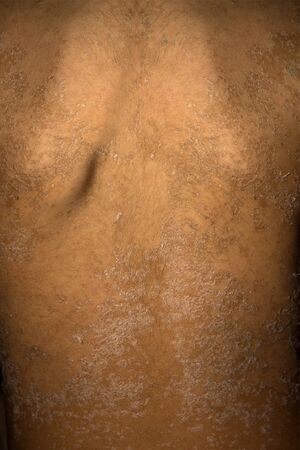 The manifestation of skin allergic dermatitis.