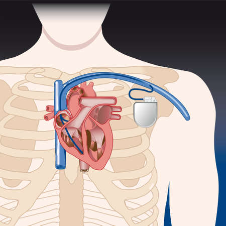 Schematic sketch of pacemaker  Elements are on a separate layer and can be easily removed  Gradients...