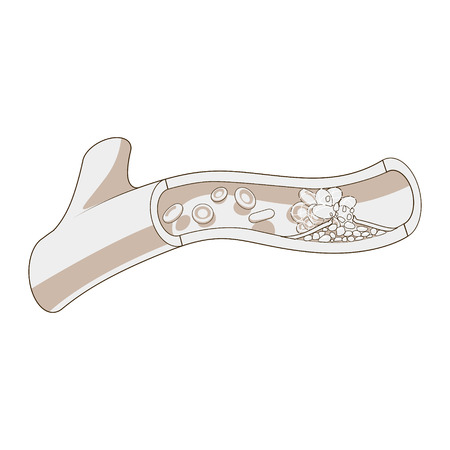 Blood vessel and clot thrombus medical science educational vector illustrationのイラスト素材
